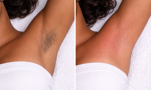 Professional underarm waxing service in Orlando, Florida, leaving armpits smooth and irritation-free