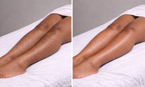 Professional female leg waxing service in Orlando, Florida, leaving legs smooth and hair-free