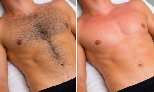 Professional male chest waxing service in Orlando, Florida, removing unwanted hair for smooth and clean skin
