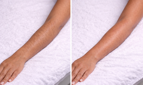 Professional arm waxing service for women in Orlando, Florida, leaving the skin smooth, clean, and hair-free